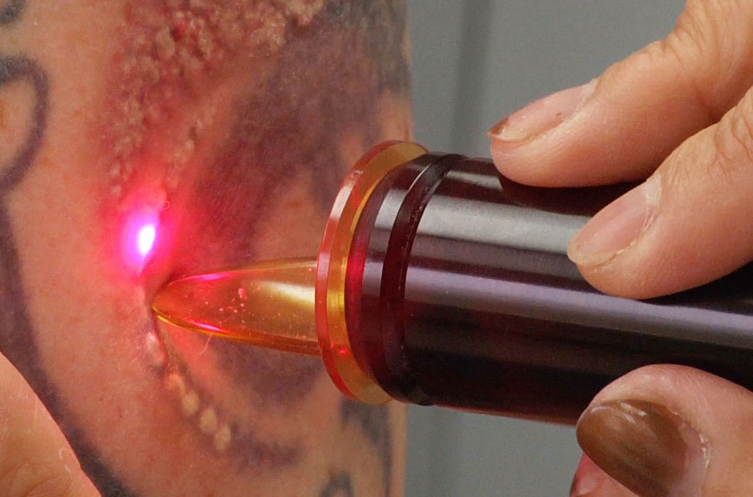 rimuovere tatuaggio con il laser